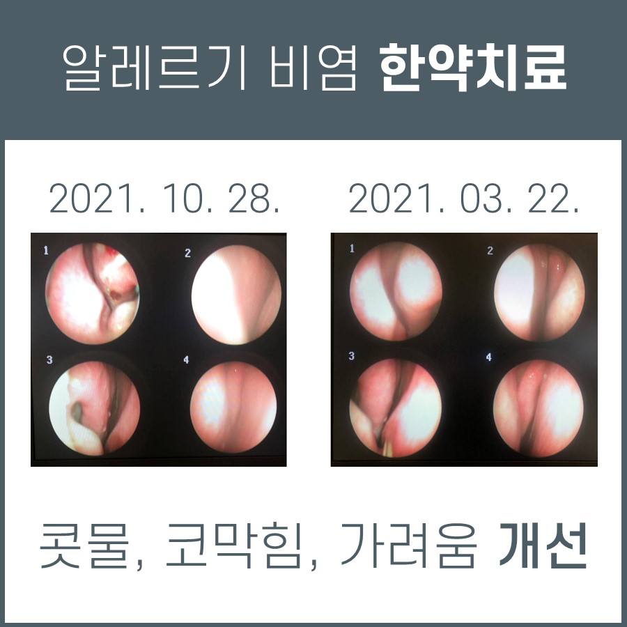 알레르기 비염, 한약 치료 효과 입증