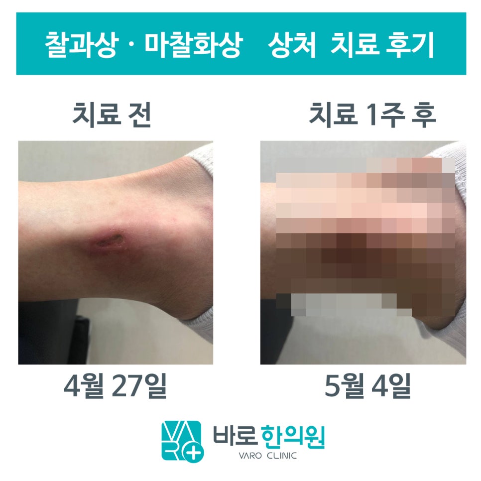 발목에 생긴 찰과상 치료 전과 1주 후의 모습.