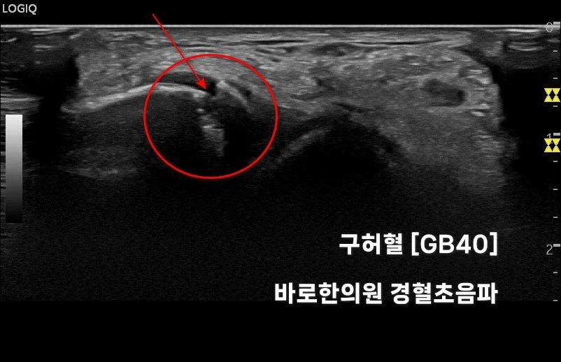 발목 부위의 구허혈(GB40)을 표시한 초음파 사진 — 초음파 정밀 진단 | 서울 바로한의원 초음파 약침·도침·침도
