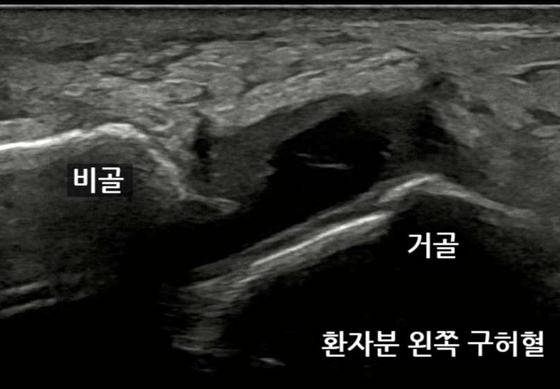 발목 초음파 사진으로, 비골과 거골 사이의 인대 파열이 보이는 모습.