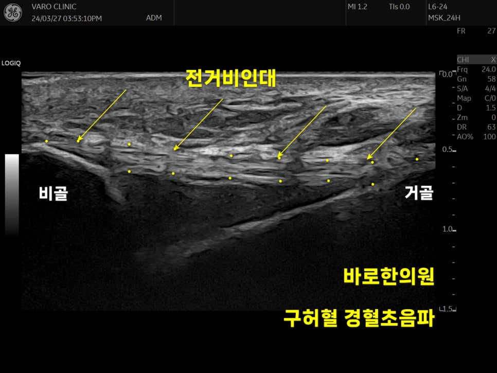 발목 전거비인대 초음파 사진으로, 비골과 거골 사이의 인대를 노란색 화살표로 표시한 모습.