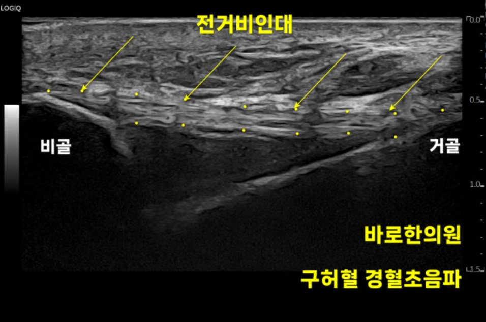 발목 전거비인대 초음파 사진으로, 비골과 거골 사이에 있는 인대를 보여줍니다.