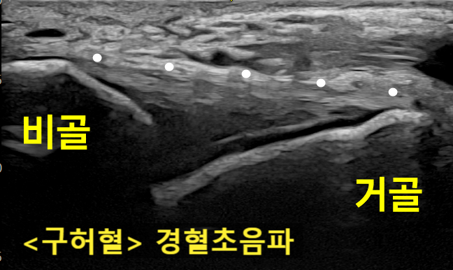 발목 앞쪽 초음파 사진으로 비골과 거골, 전거비인대가 보이며, '구허혈 경혈초음파'라는 문구가 있다.