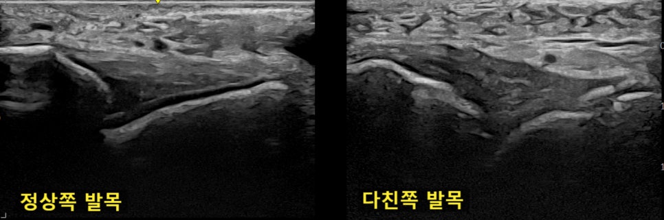 정상 발목과 다친 발목의 초음파 비교 영상