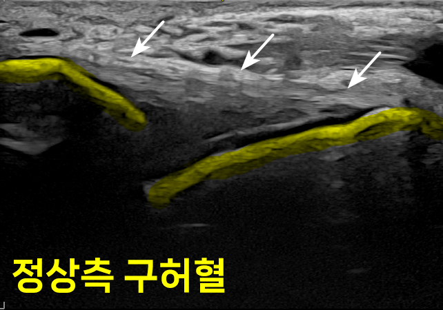 발목 부위의 초음파 사진으로, 노란색으로 표시된 인대와 화살표로 가리킨 주변 조직이 보인다. 화면 하단에 '정상측 구허혈'이라는 글자가 있다.