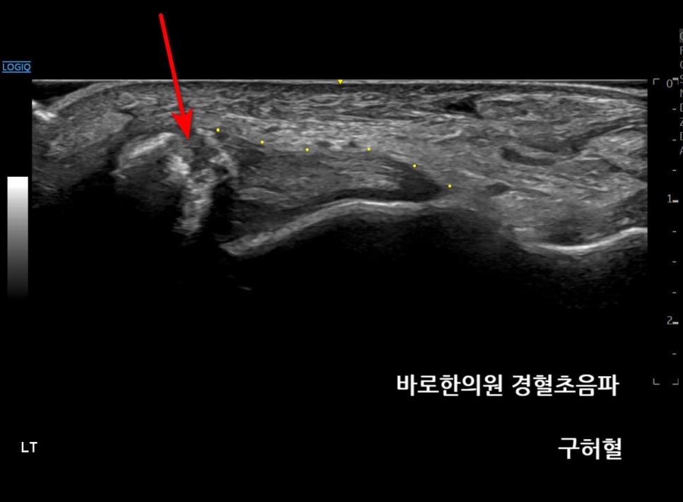 발목 부위의 초음파 사진으로, 뼈의 불규칙한 부분이 빨간색 화살표로 표시되어 있습니다.