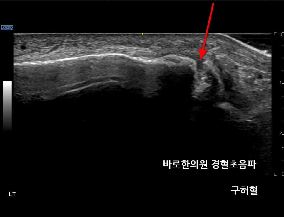 발목 바깥쪽 뼈의 초음파 사진으로, 뼈 표면의 불연속성이 화살표로 표시되어 있습니다.
