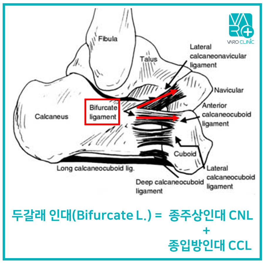 발목의 두갈래 인대(Bifurcate ligament)와 주변 인대들의 해부학적 구조를 나타낸 그림.