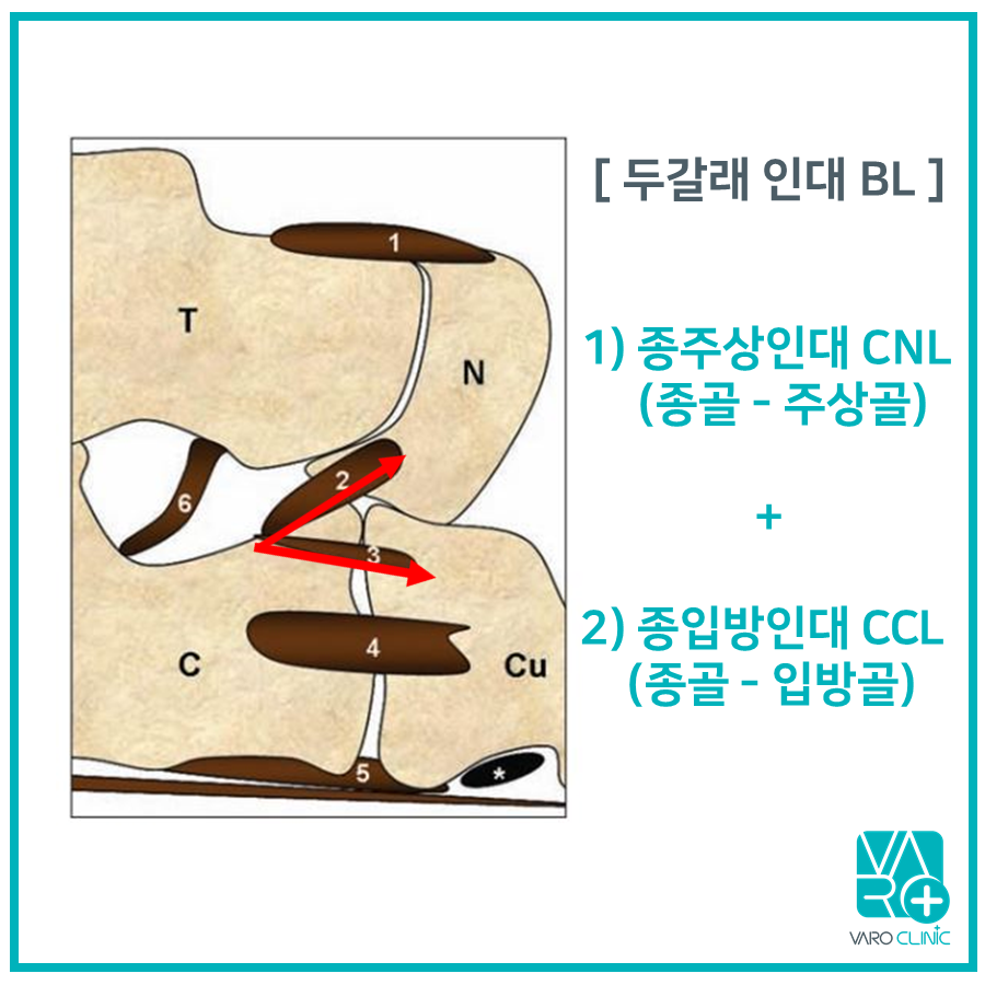 발목의 두갈래 인대와 그 구성 인대인 종주상인대, 종입방인대의 위치를 나타낸 해부학적 그림 — 서울 바로한의원 초음파 약침·도침