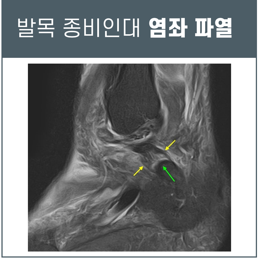 발목 종비인대 파열 부위를 화살표로 표시한 MRI 영상