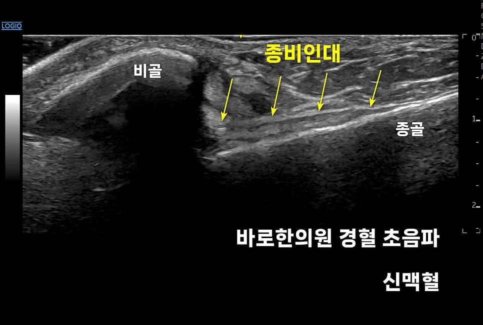 발목 초음파 사진으로, 비골과 종골 사이에 있는 종비인대를 노란색 화살표로 표시한 모습.