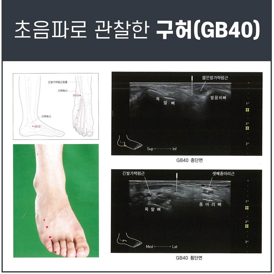 발목 부위의 구허(GB40) 혈자리 위치를 보여주는 그림과 초음파 영상
