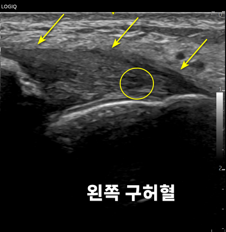 노란색 화살표와 원으로 특정 부위가 표시된 발목 부위 초음파 사진과 '왼쪽 구허혈'이라는 글자.
