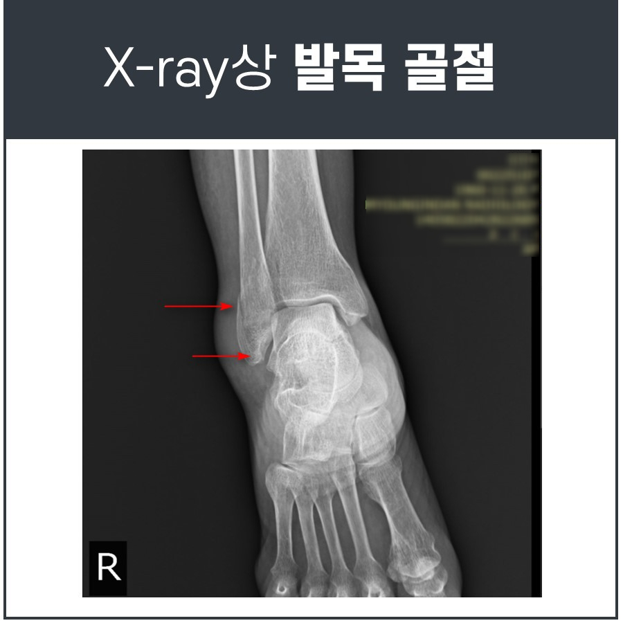 오른쪽 발목 비골 골절 부위를 빨간 화살표로 표시한 X-ray 사진