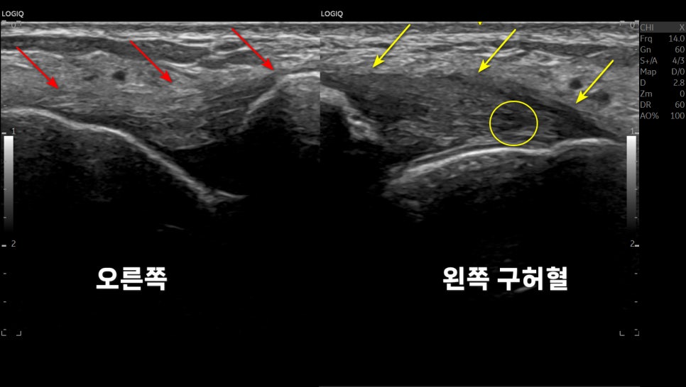 오른쪽과 왼쪽 구허혈 부위를 보여주는 초음파 이미지로, 화살표와 원으로 특정 영역이 강조되어 있다.