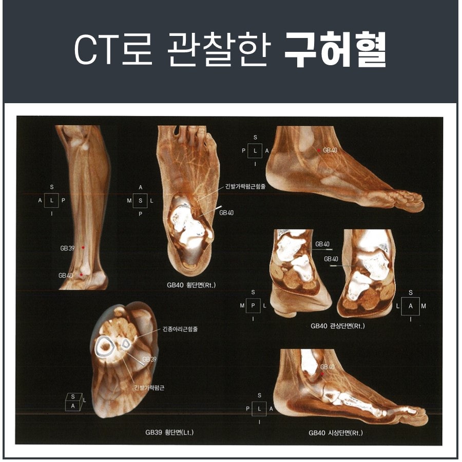 발목과 발의 뼈와 힘줄, 혈자리를 다양한 각도에서 보여주는 CT 스캔 이미지.