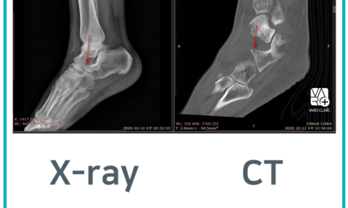 발목 X-ray와 CT 촬영 사진을 나란히 보여주며, 각 사진에 붉은 화살표가 특정 부위를 가리키고 있습니다.