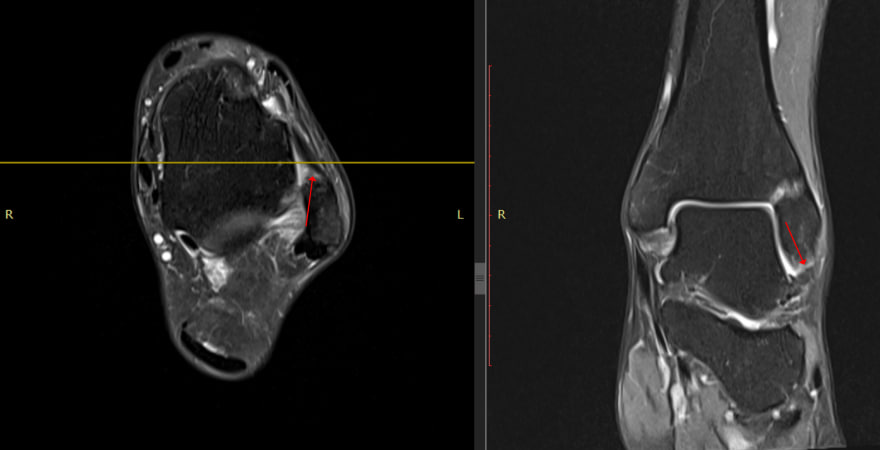 발목 인대 부위의 MRI 영상으로, 붉은 화살표가 특정 부위를 가리키고 있습니다 — 서울 바로한의원 초음파 약침·도침