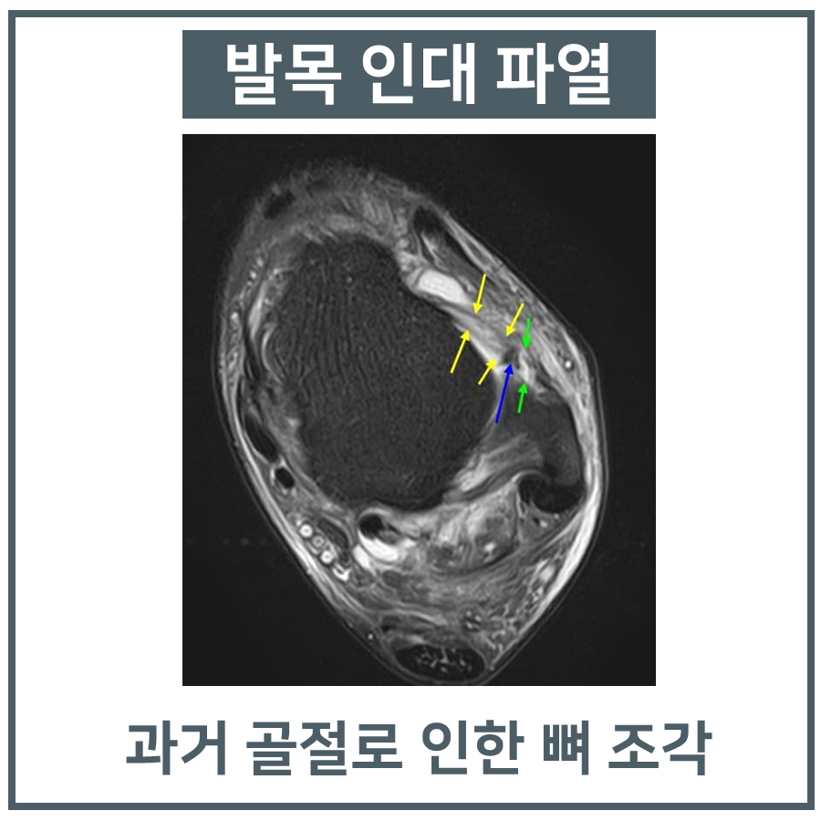 발목 MRI 영상에서 파열된 인대와 과거 골절로 인한 뼈 조각이 보이는 모습 — 서울 바로한의원 초음파 약침·도침