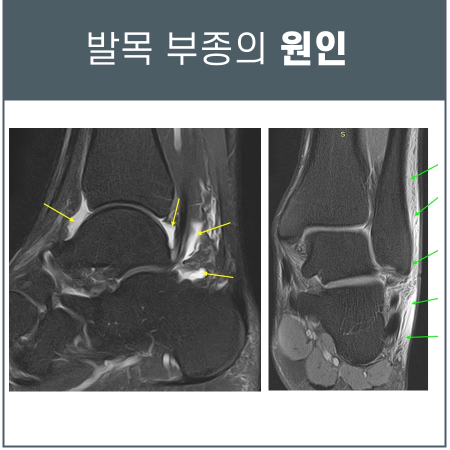 발목의 두 가지 MRI 영상으로, 노란색 화살표는 인대 손상 부위를, 초록색 화살표는 부종 부위를 나타낸다.
