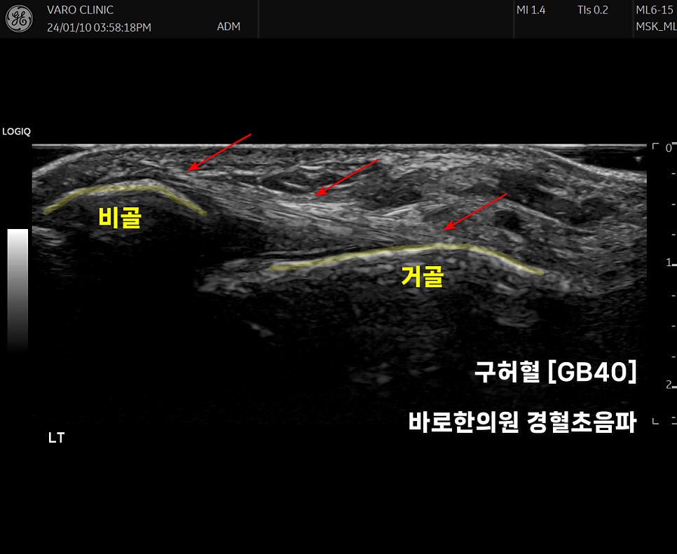 발목 관절의 비골과 거골 사이 인대를 보여주는 초음파 이미지 — 초음파 정밀 진단 | 서울 바로한의원 초음파 약침·도침·침도