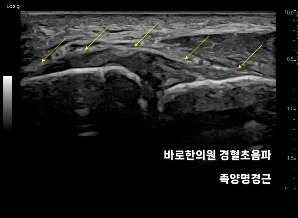 발목 부위의 연부 조직을 보여주는 초음파 영상으로, 노란색 화살표가 특정 인대 또는 건 구조를 가리키고 있습니다.