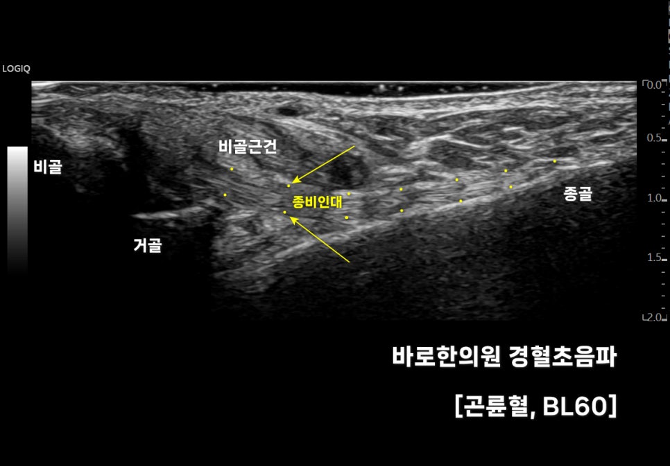 발목 부위의 비골, 거골, 종골, 비골근건, 종비인대를 표시한 초음파 이미지