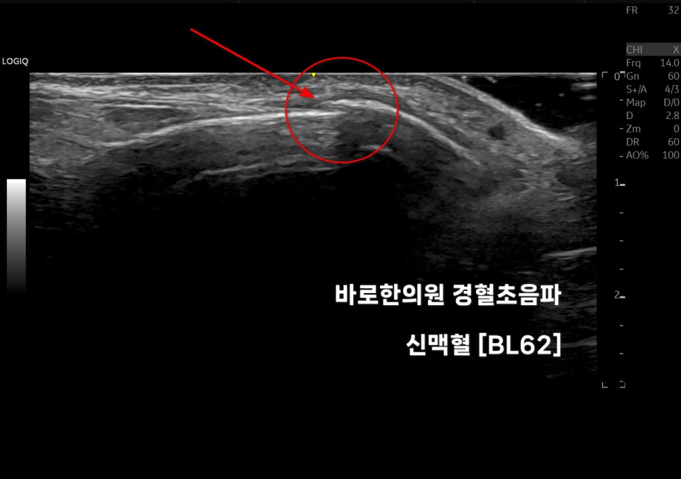 발목 신맥혈(BL62) 경혈 초음파 사진으로, 붉은 원과 화살표가 특정 부위를 표시하고 있습니다.