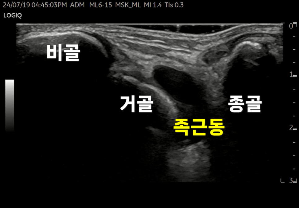 발목 초음파 사진으로 비골, 거골, 종골, 족근동이 표시되어 있다.