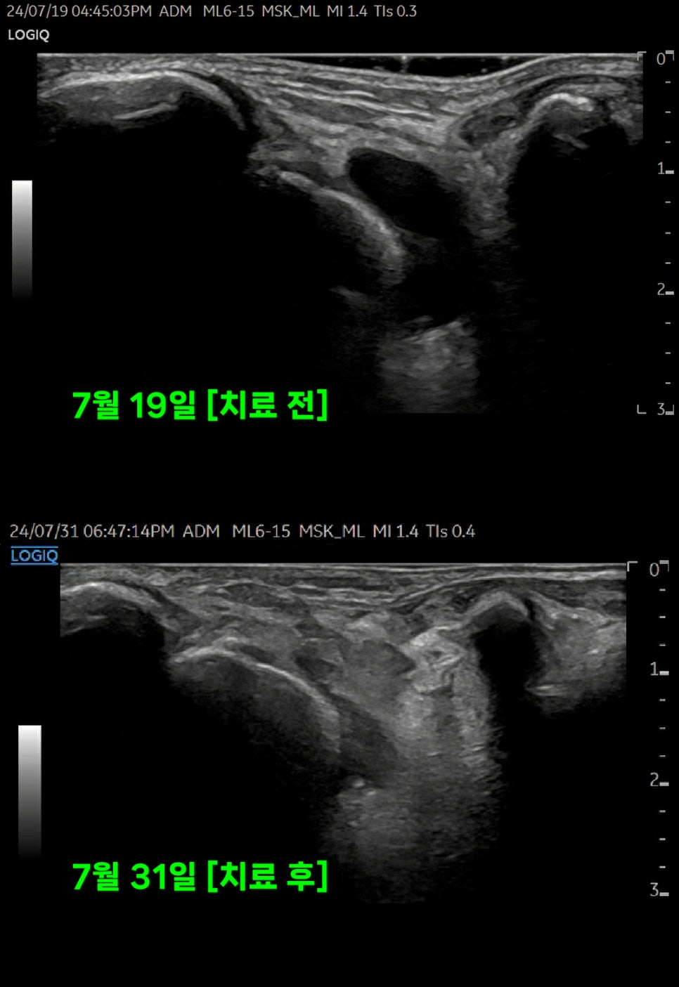 발목 족근동 초음파 치료 전후 비교 사진