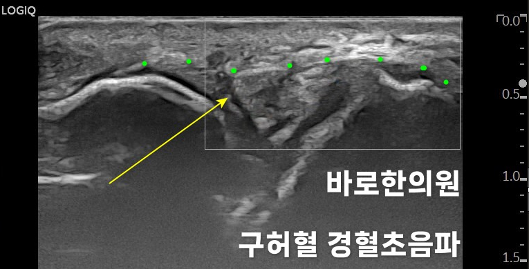 발목 인대 초음파 사진으로, 노란색 화살표가 특정 부위를 가리키고 있으며 녹색 점들이 표시되어 있다. 이미지 하단에 '바로한의원 구허혈 경혈초음파' 문구가 있다.