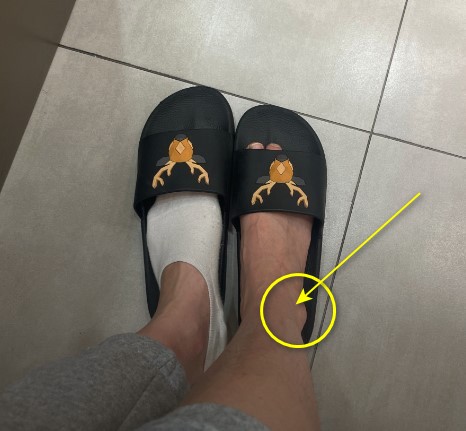검은색 슬리퍼를 신은 발 두 개가 보이며, 오른쪽 발의 바깥쪽 복숭아뼈 부위가 노란색 화살표와 원으로 표시되어 있다.