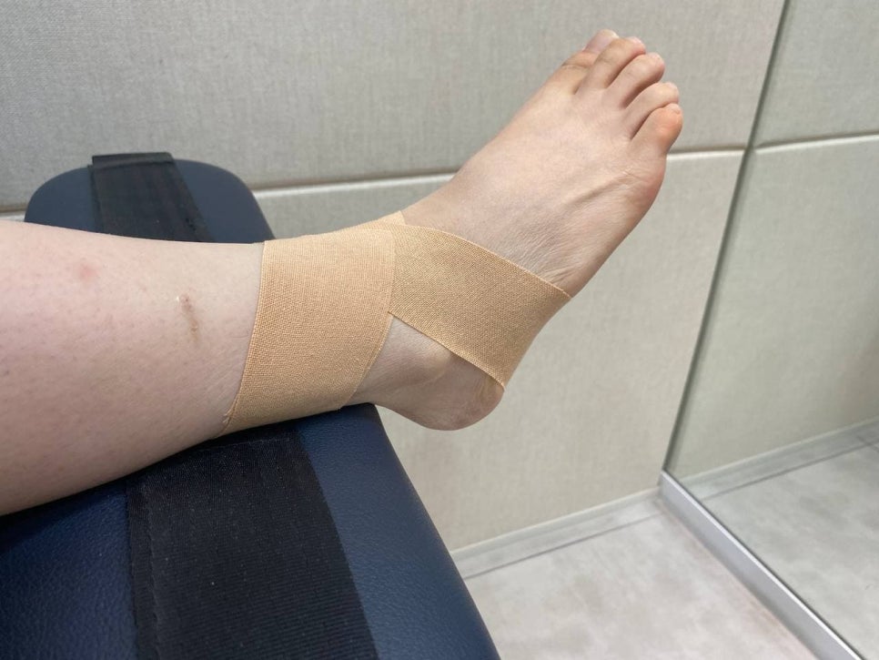 발목에 베이지색 테이프가 감겨 있는 모습 — 서울 바로한의원 초음파 약침·도침
