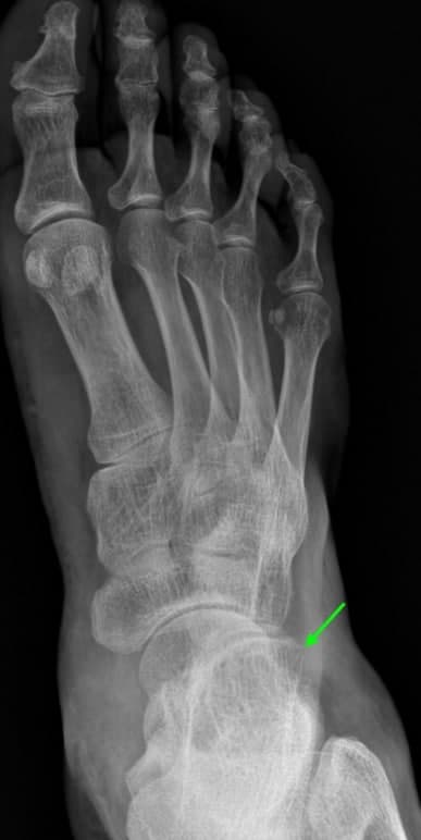 발목 X-ray 사진에서 외측 복사뼈 부근에 녹색 화살표가 가리키는 작은 뼈 조각이 보인다.