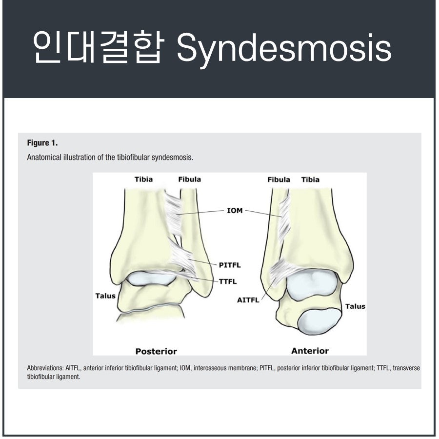 발목 인대결합의 해부학적 구조를 후면과 전면에서 보여주는 그림으로, 경골, 비골, 거골 및 관련 인대들이 표시되어 있습니다.