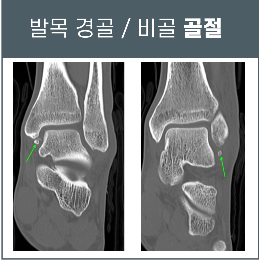발목 경골과 비골 주변에 작은 골절 조각이 보이는 CT 영상 두 장.