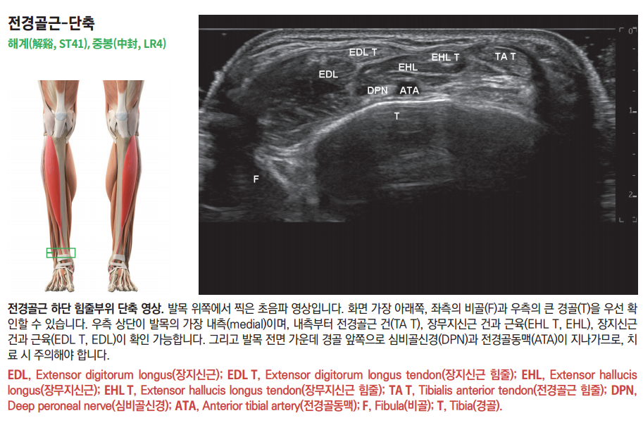 발목 앞쪽 근육 해부학 그림과 함께 비골, 경골, 전경골근 건, 장무지신근 건, 장지신근 건, 심비골신경, 전경골동맥이 표시된 발목 초음파 영상.