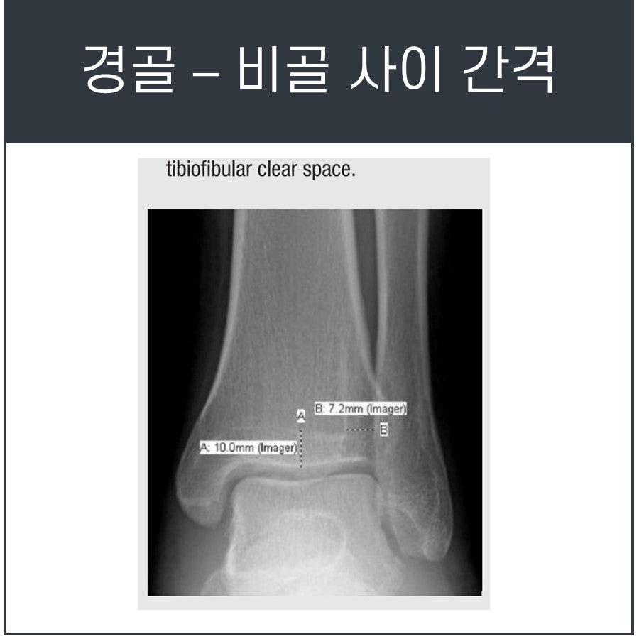 발목 엑스레이 사진에서 경골과 비골 사이 간격을 측정한 모습