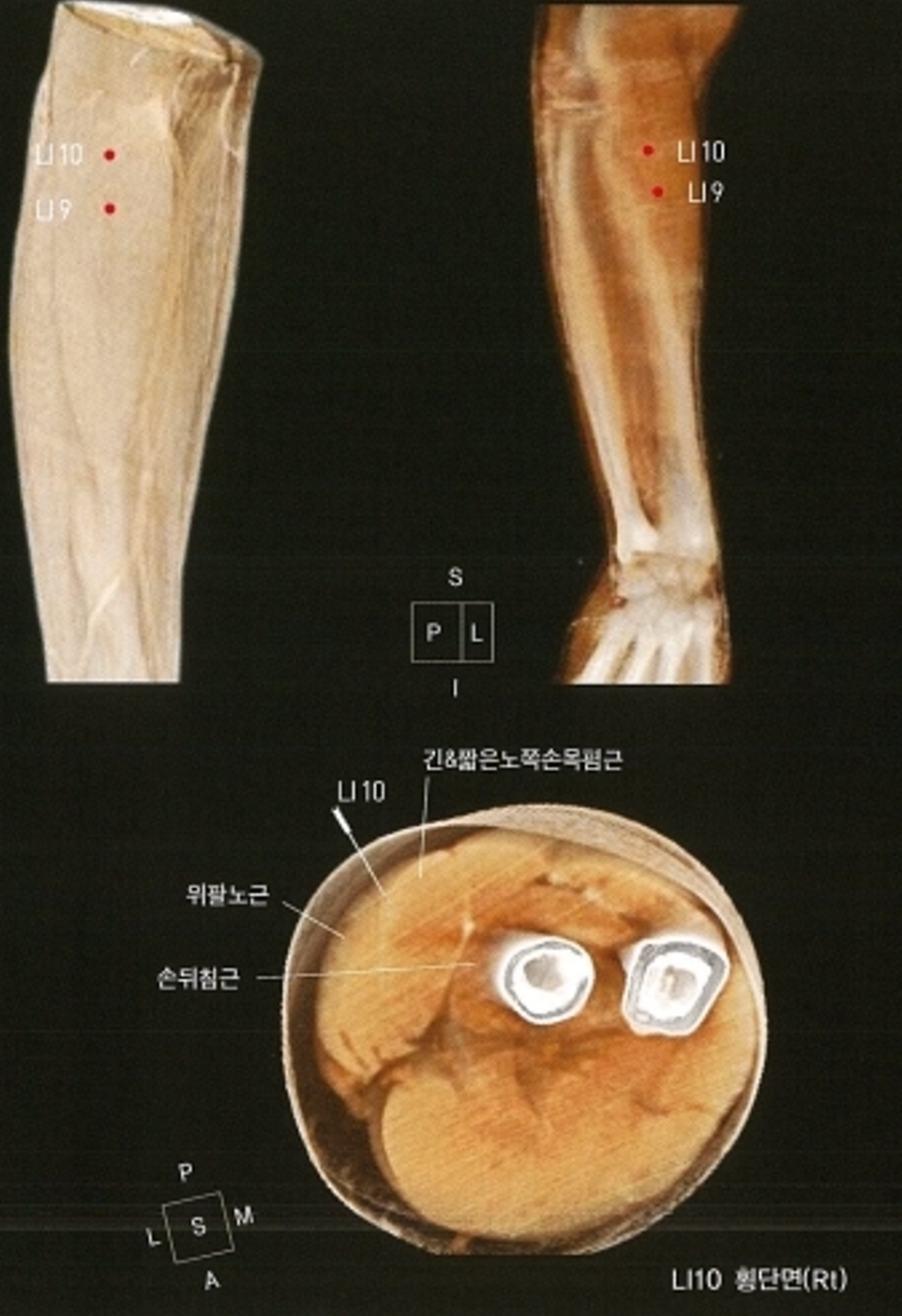 팔과 전완의 LI9, LI10 경혈 위치를 표시한 의료 영상과 해당 부위의 근육 및 뼈 횡단면 영상.