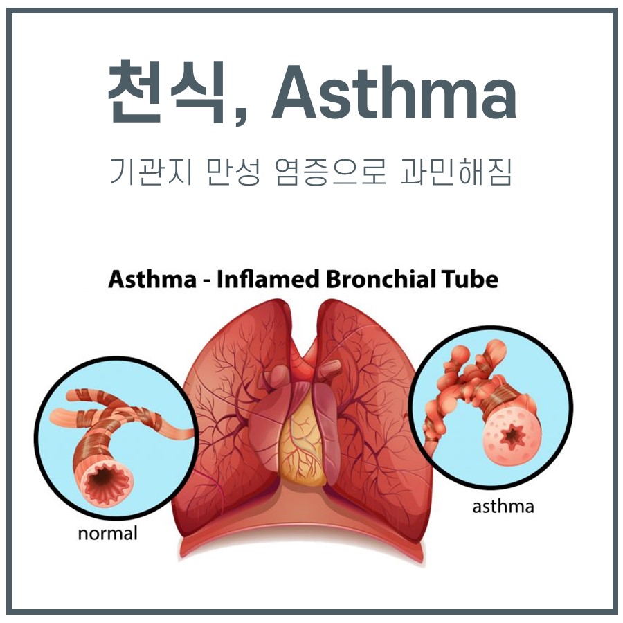 천식과 정상 기관지를 비교하는 폐 및 기관지 단면도 일러스트 — 서울 바로한의원 초음파 약침·도침