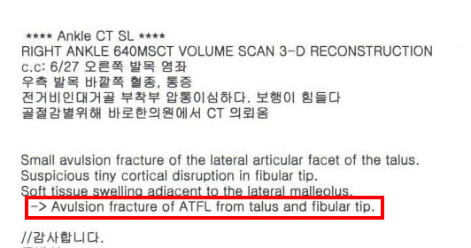 발목 CT 검사 결과, 전거비인대 견열 골절 소견이 기록된 문서