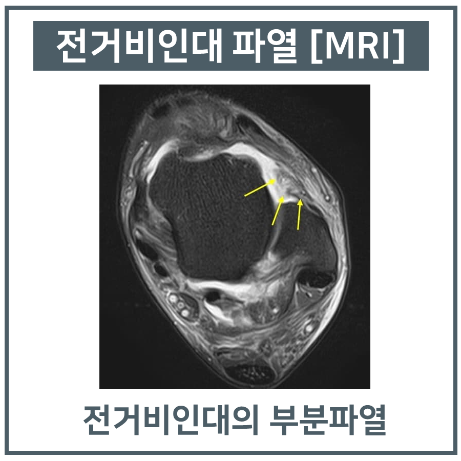 발목 MRI 영상에서 전거비인대의 부분 파열이 노란 화살표로 표시되어 있다 — 서울 바로한의원 초음파 약침·도침