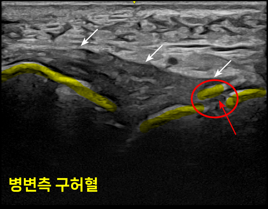 발목 앞쪽 통증 부위의 초음파 영상으로, '병변측 구허혈'이라는 글자와 함께 화살표와 빨간색 원으로 표시된 병변 부위, 그리고 노란색으로 강조된 구조물이 보인다.