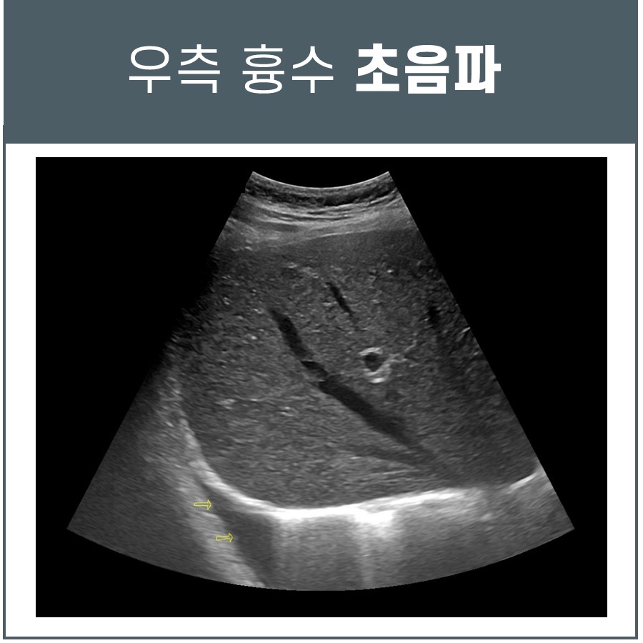 옆구리 통증, 근육통? 결핵성 늑막염일 수 있습니다