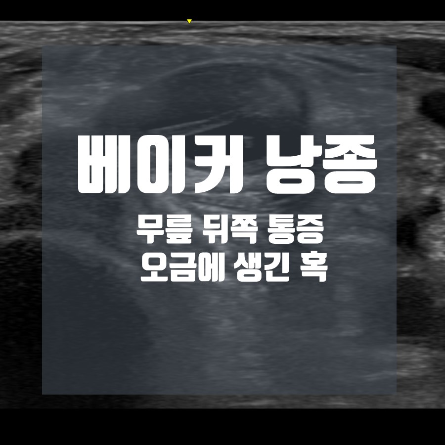 베이커 낭종, 무릎 뒤쪽 통증, 오금에 생긴 혹이라는 문구가 적힌 초음파 사진 — 초음파 정밀 진단 | 서울 바로한의원 초음파 약침·도침·침도