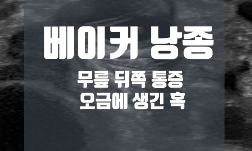 베이커 낭종, 무릎 뒤쪽 통증, 오금에 생긴 혹이라는 문구가 있는 초음파 이미지