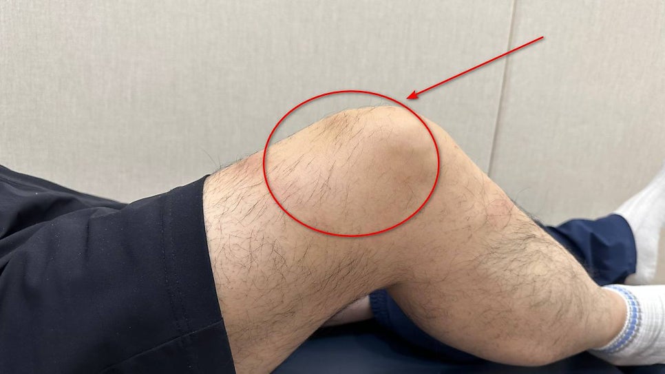 구부러진 무릎에 부기가 있는 부위를 빨간색 원과 화살표로 표시한 사진.