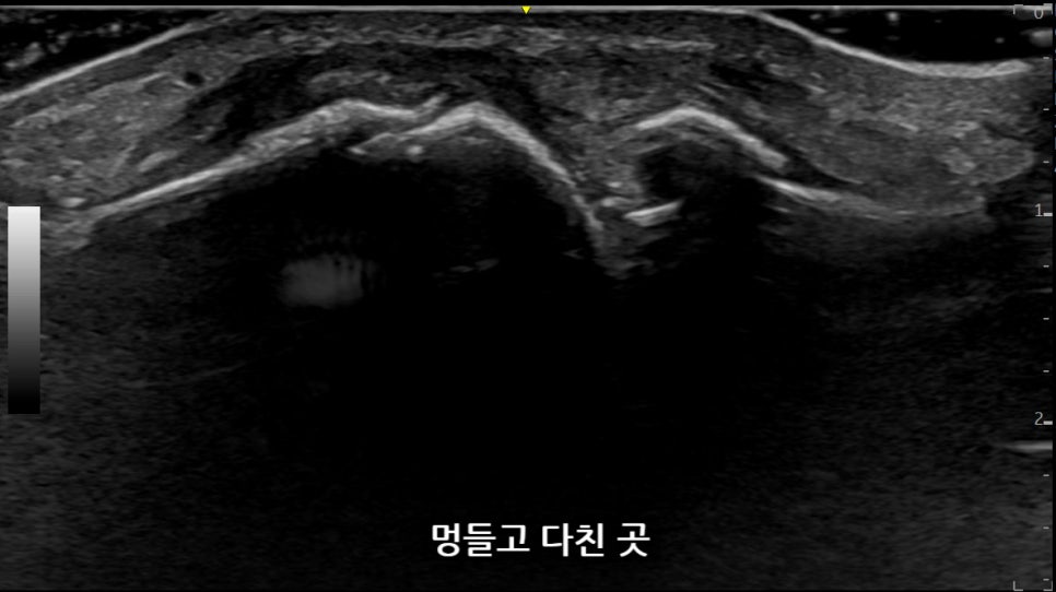 엄지발가락 멍들고 다친 부위의 초음파 사진