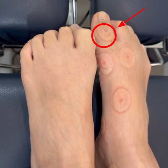 위에서 내려다본 두 발 중 오른쪽 발 엄지발가락과 발등에 둥근 부항 자국이 여러 개 보이며, 엄지발가락의 자국은 빨간 원과 화살표로 표시되어 있다.