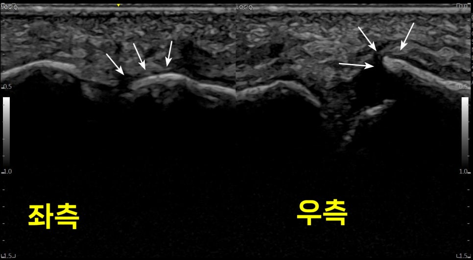 엄지발가락 관절의 좌우 초음파 비교 사진으로, 우측 관절의 골절 부위를 화살표로 표시합니다.